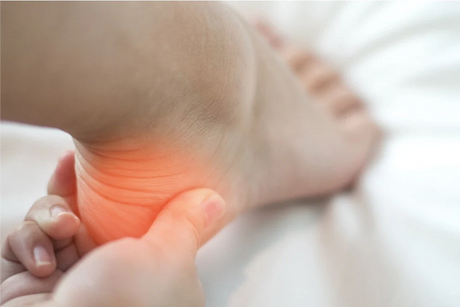 Pinteni calcaneeni – Cum să ameliorezi simptomele prin remedii la domiciliu